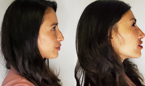 Non Surgical Nose Correction Before After Mississauga Oakville